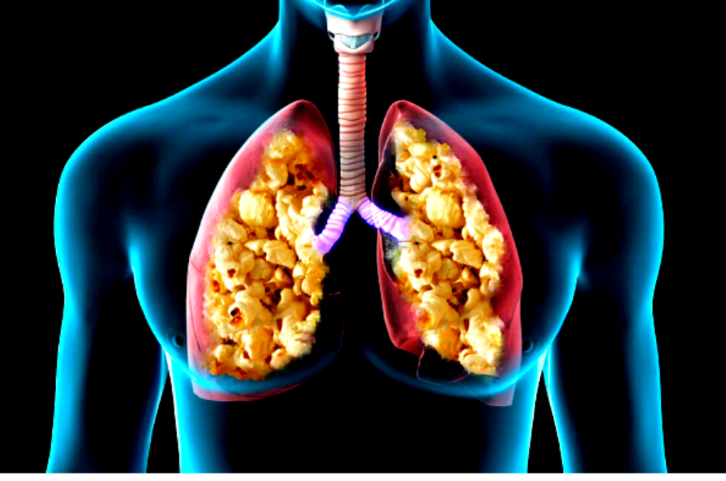 Do e-cigarettes cause popcorn lung